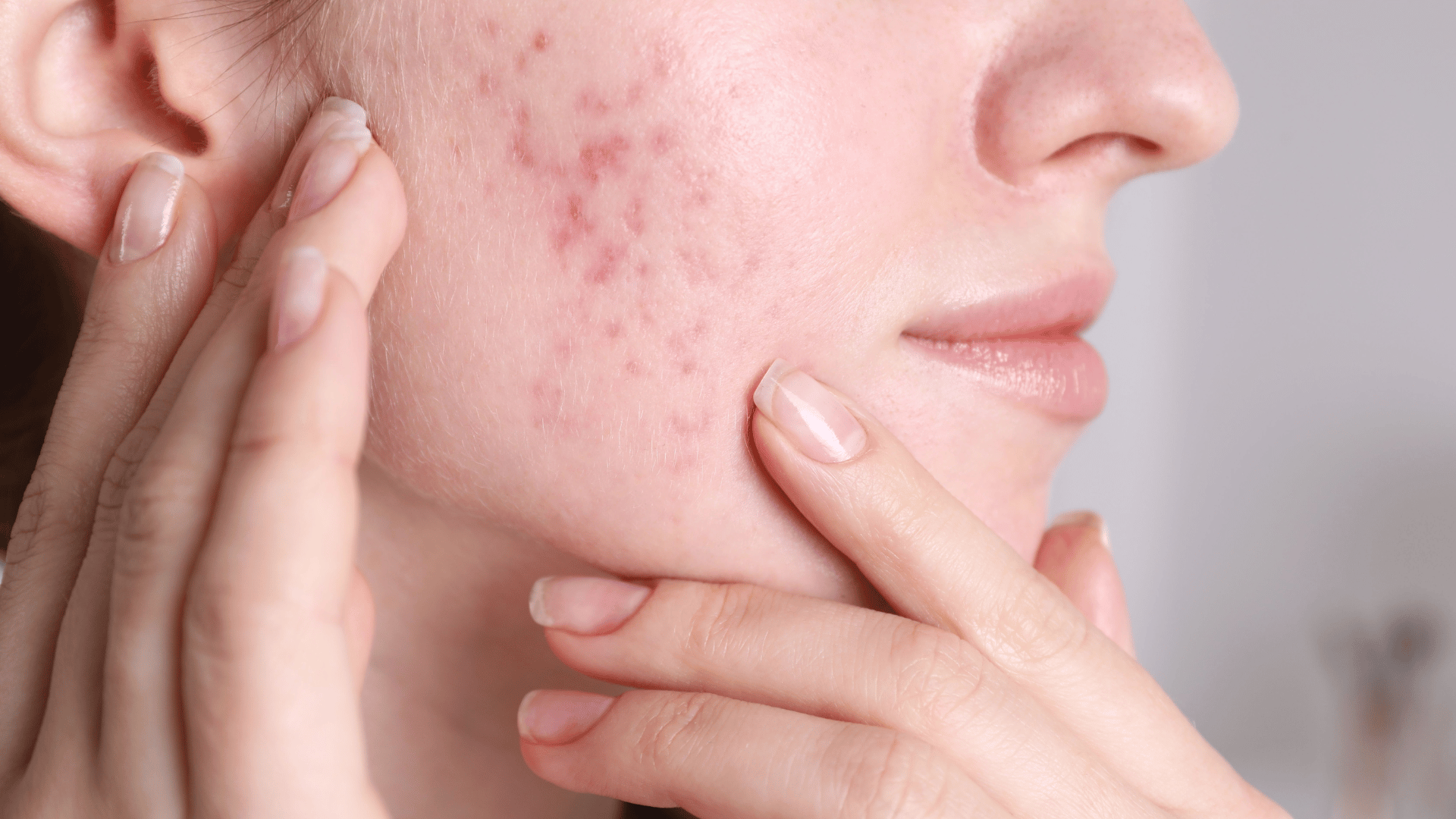 Tratamento de acne e rosácea no Rio de Janeiro com especialistas em dermatologia clínica. Cuidados personalizados para uma pele saudável e bonita.