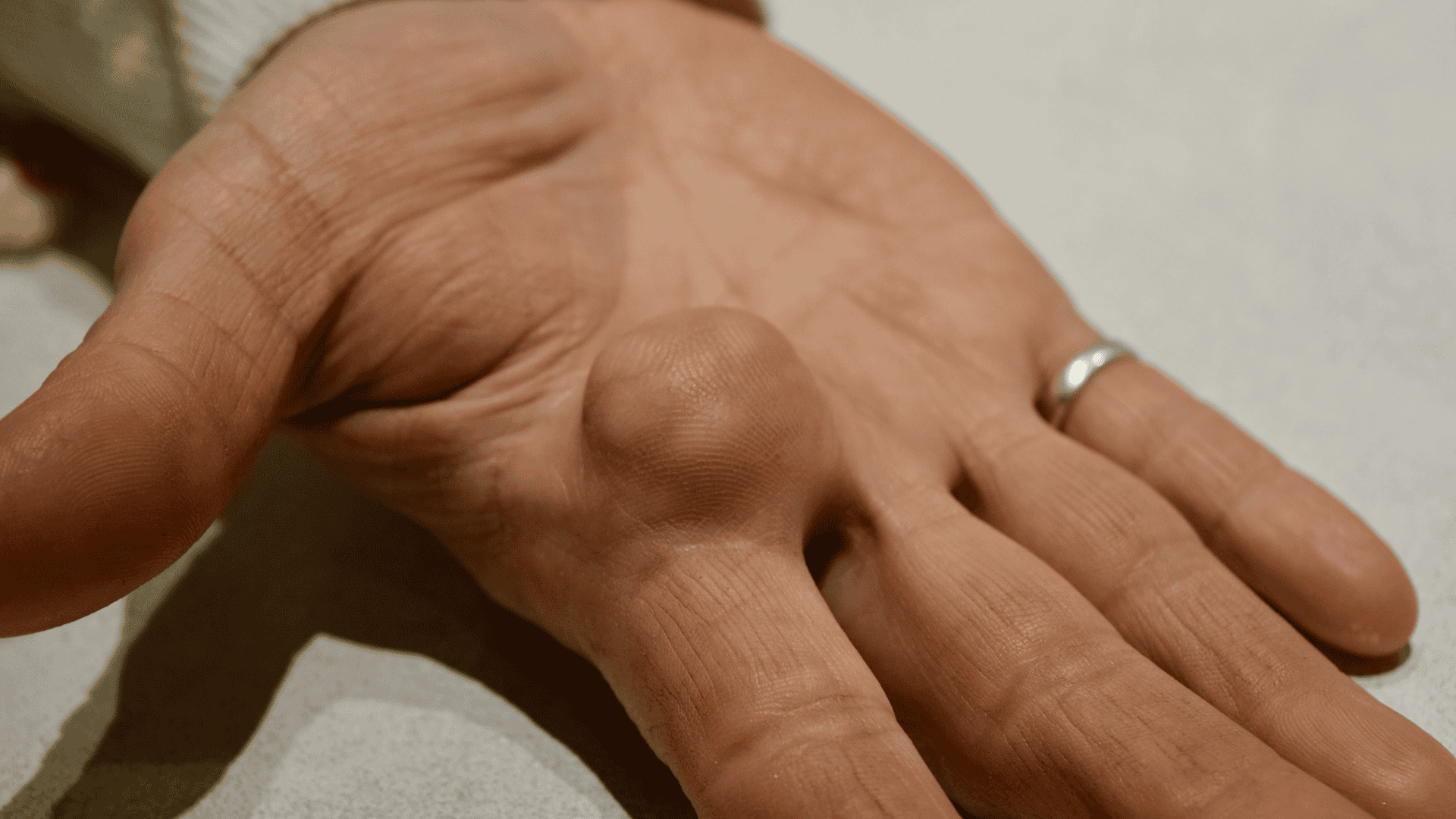 Cirurgia para cistos e lipomas no Rio de Janeiro. Remoção segura com especialistas para um resultado estético e eficaz.