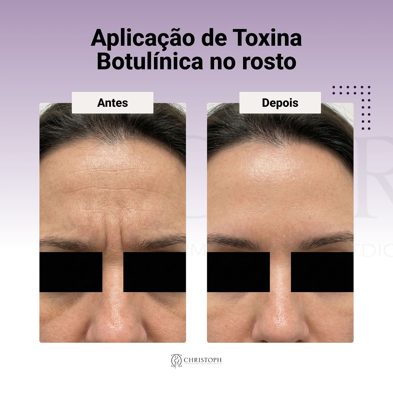 Aplicação de Toxina Botulínica no rosto-1 1