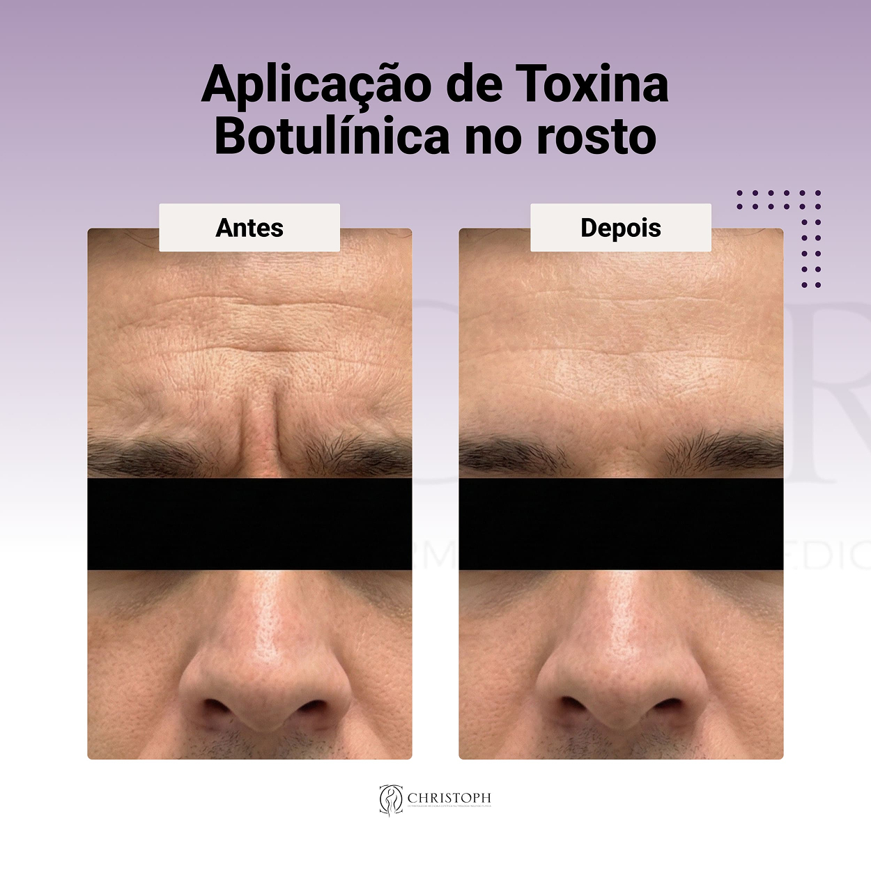 Aplicação de Toxina Botulínica no rosto 1