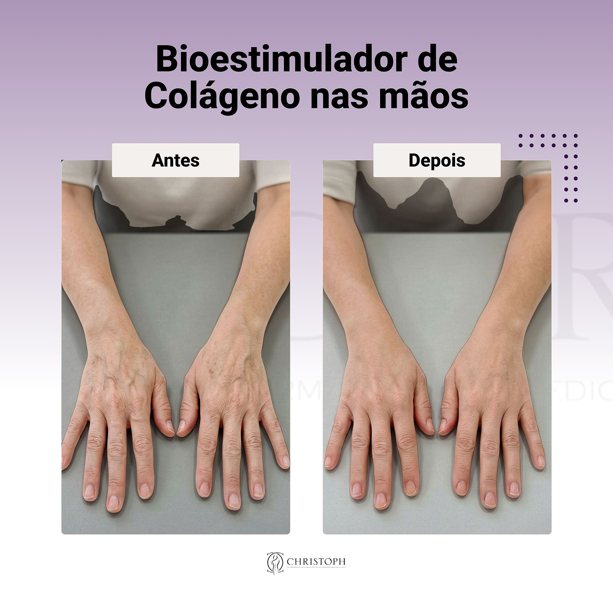 Bioestimulador de Colágeno nas mãos 1