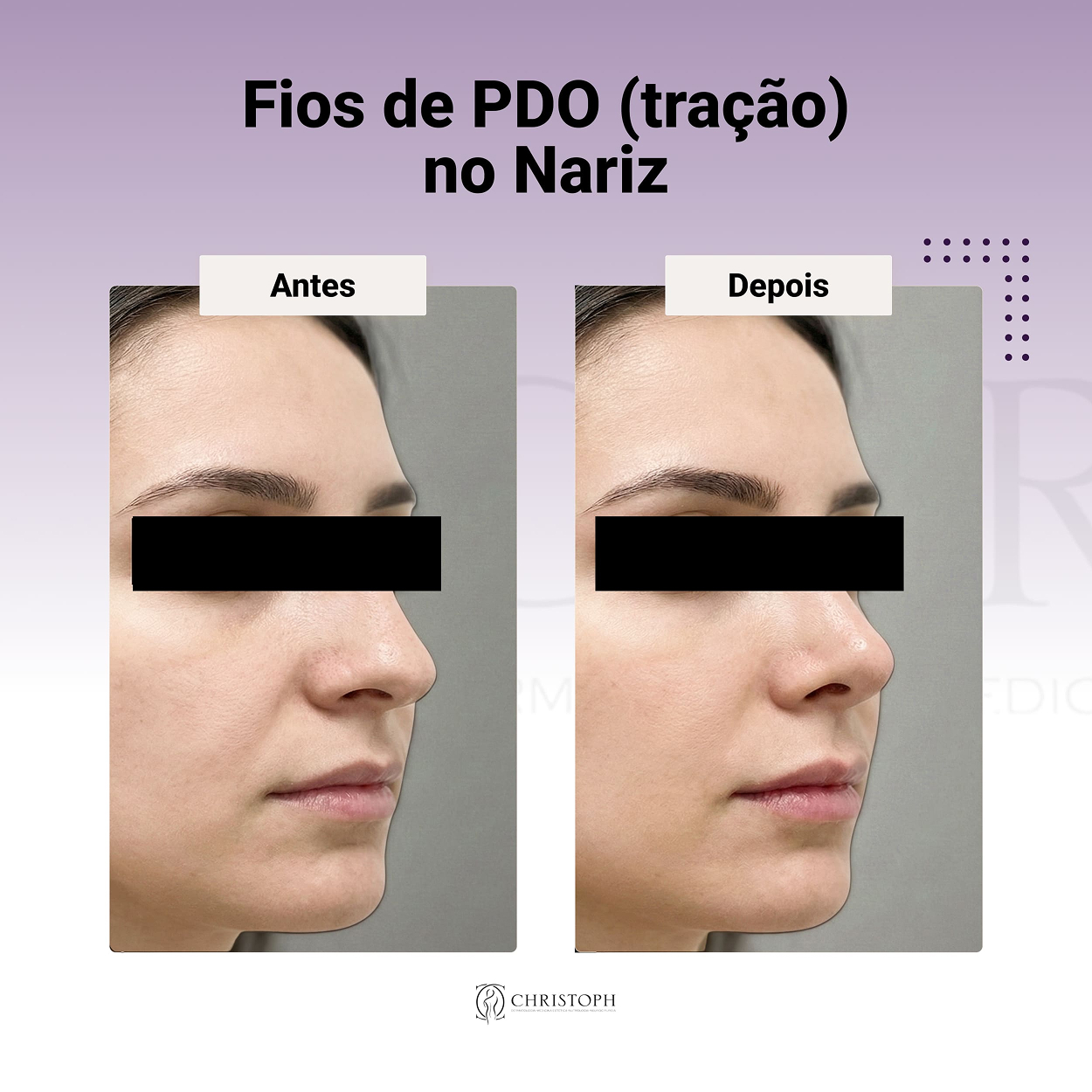 Fios de PDO (tração) no Nariz 1