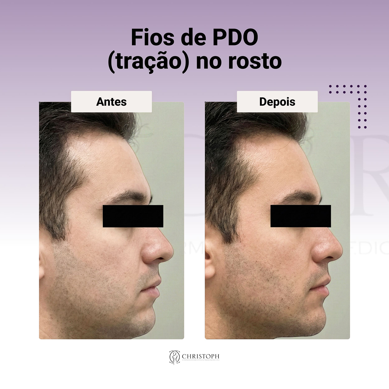Fios de PDO (tração) no rosto 1