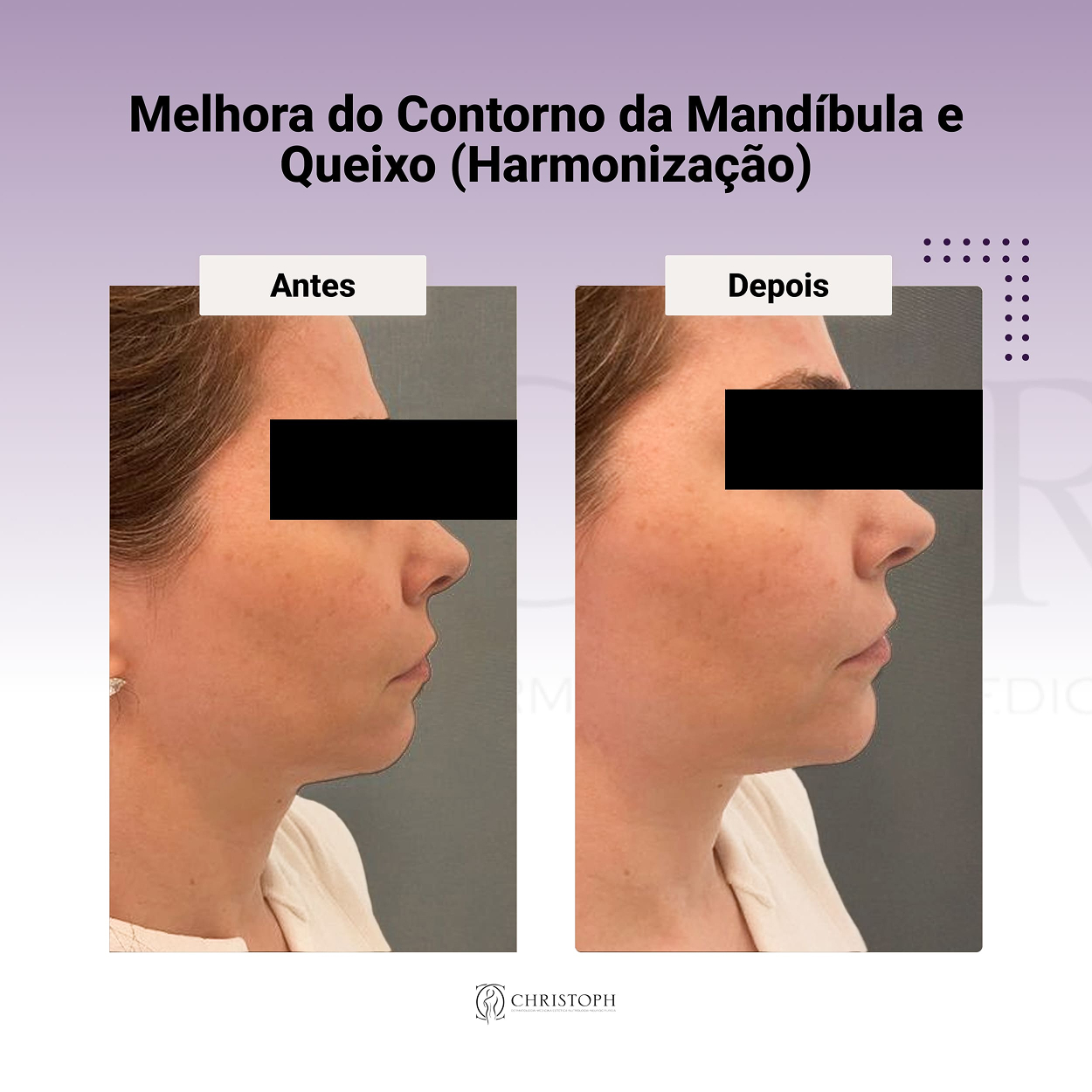Melhora do contorno da mandíbula e queixo (harmonização) 1