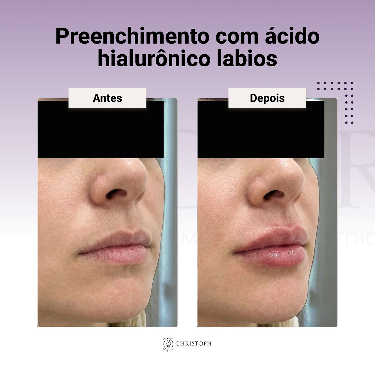 Preenchimento com ácido hialurônico labios 1