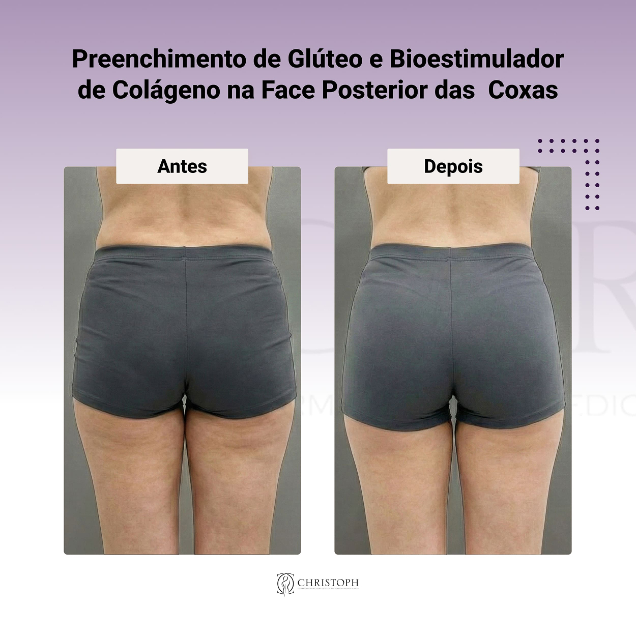Preenchimento de glúteo e bioestimulador de colageno 1