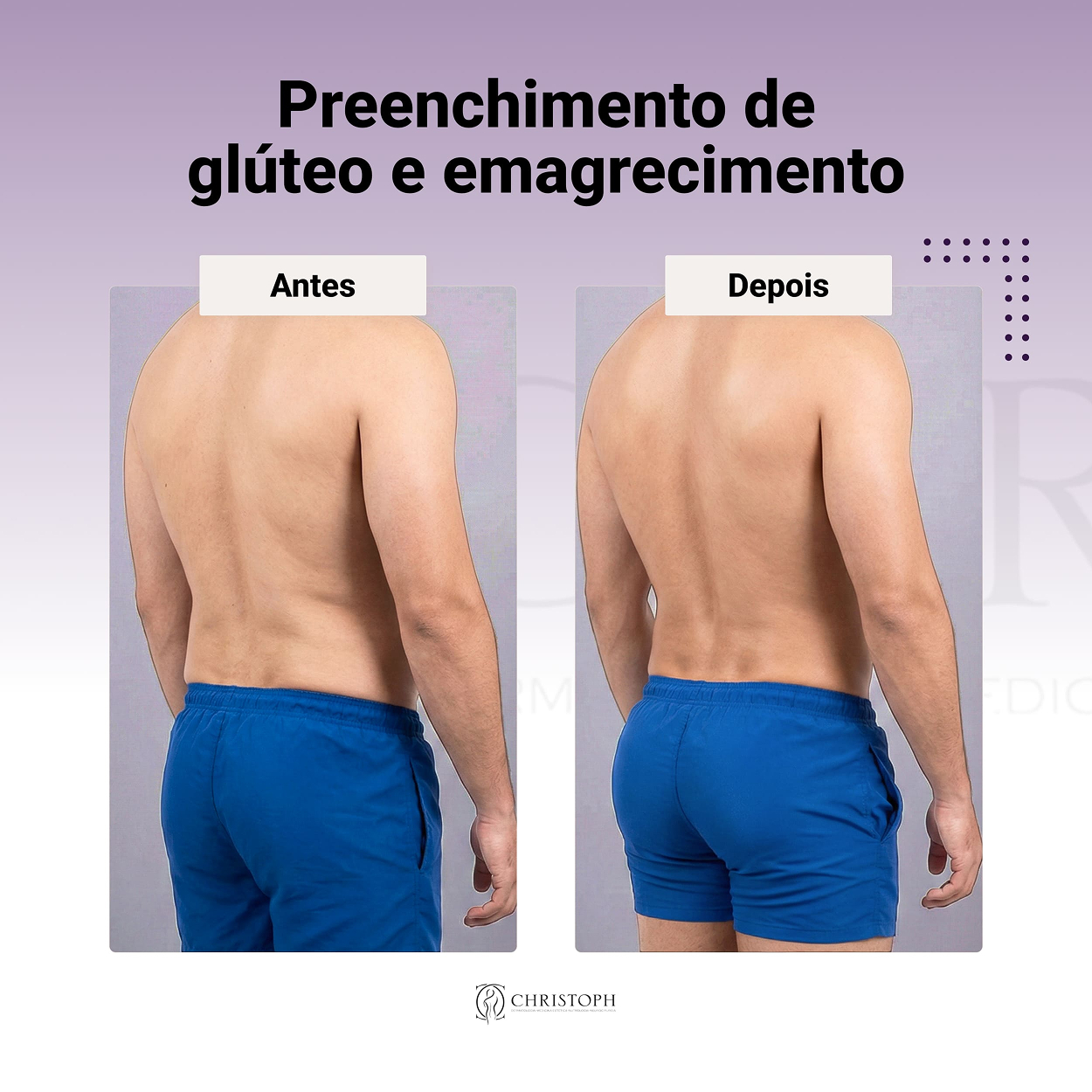 Preenchimento de glúteo e emagrecimento 1