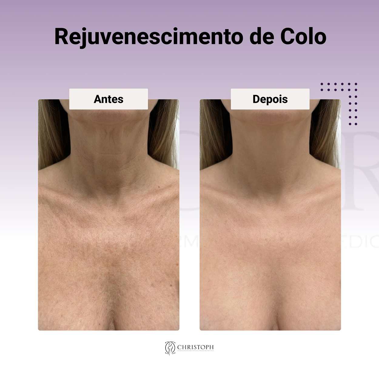 Rejuvenescimento de colo 1