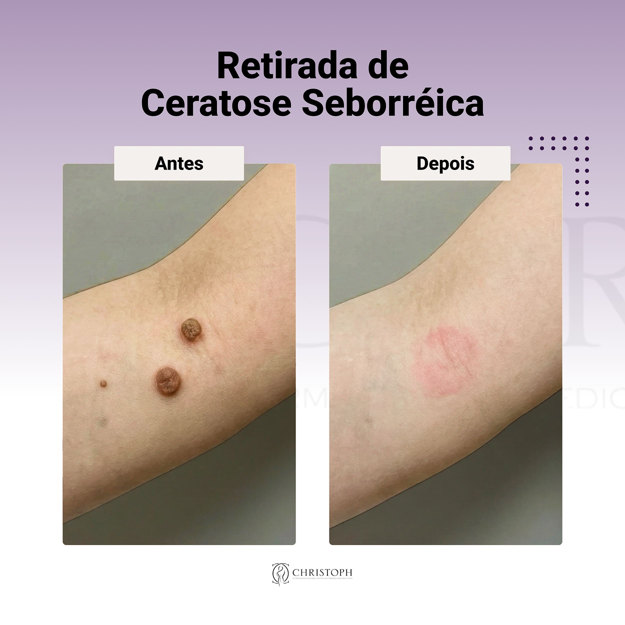 Retirada de Ceratose Seborréica 1