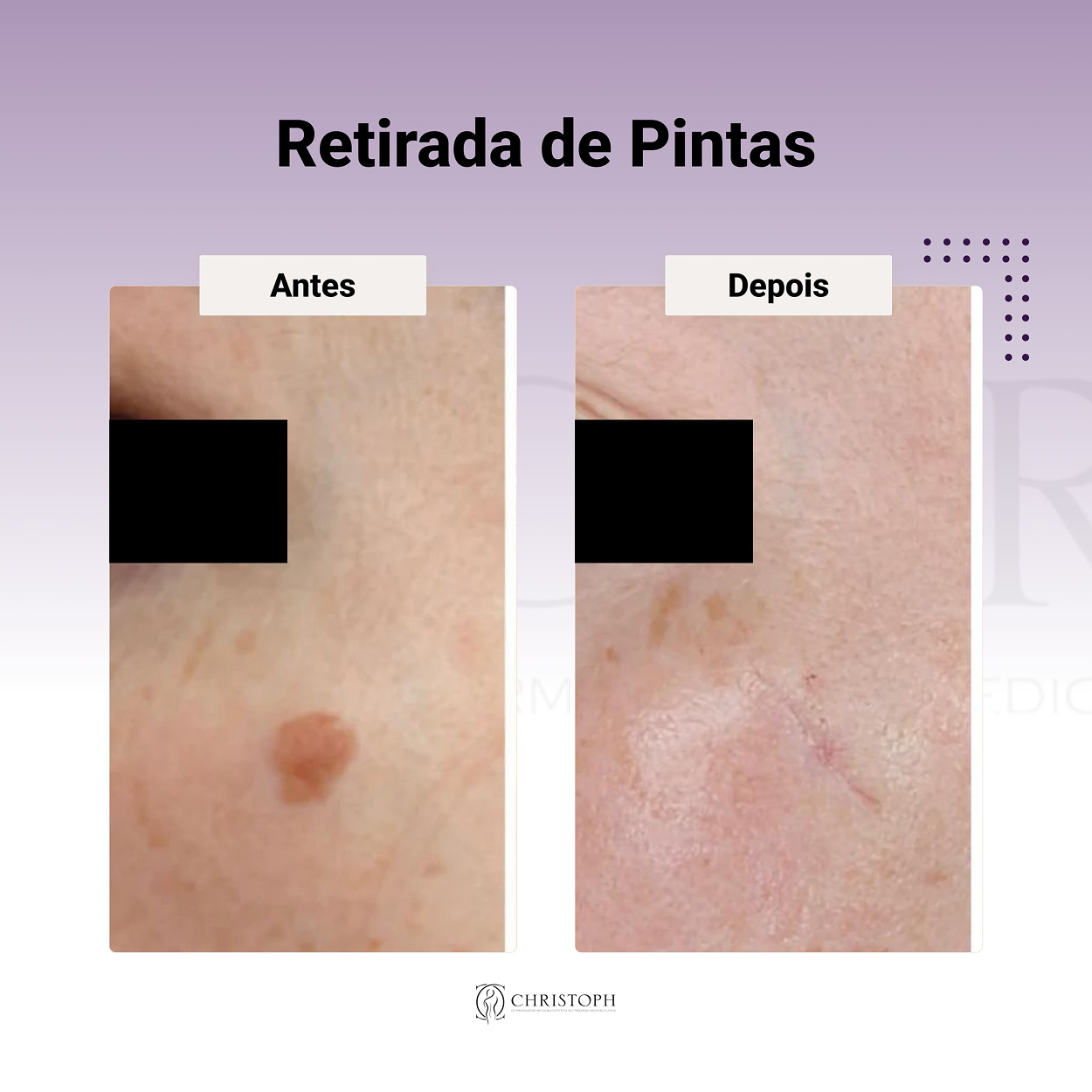 Retirada de Pintas 1