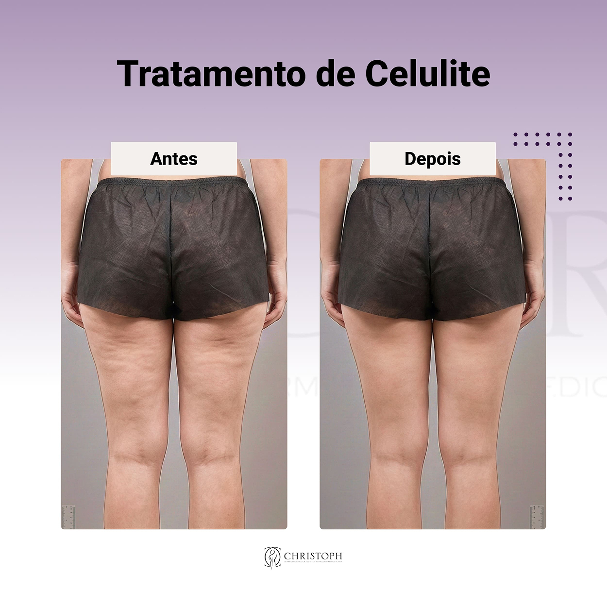 Tratamento de Celulite 1