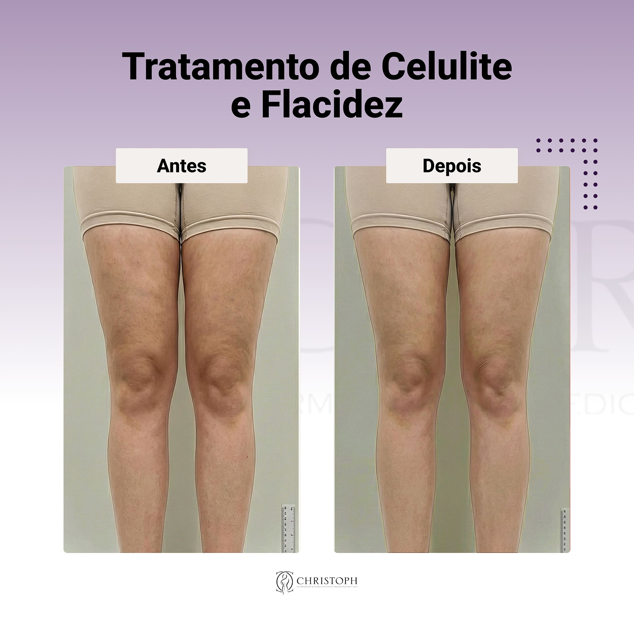 Tratamento de Celulite e Flacidez 1
