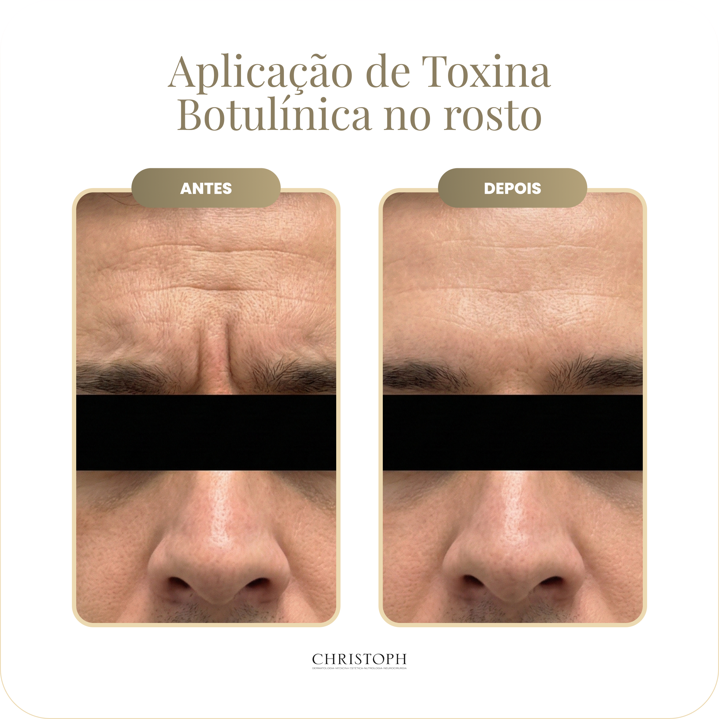 aplica_o_de_toxina_botul_nica_no_rosto-homem.webp