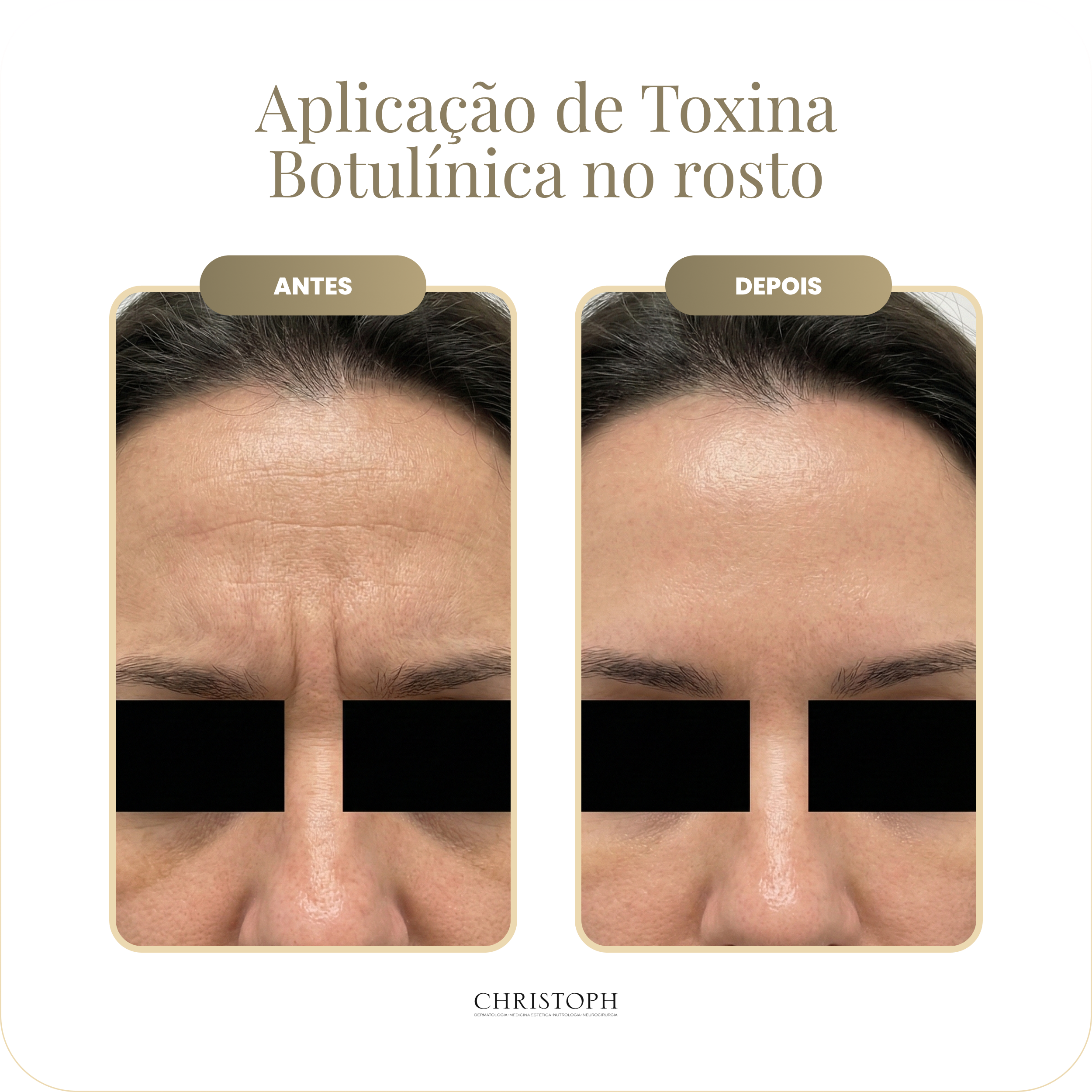 aplica_o_de_toxina_botul_nica_no_rosto.webp