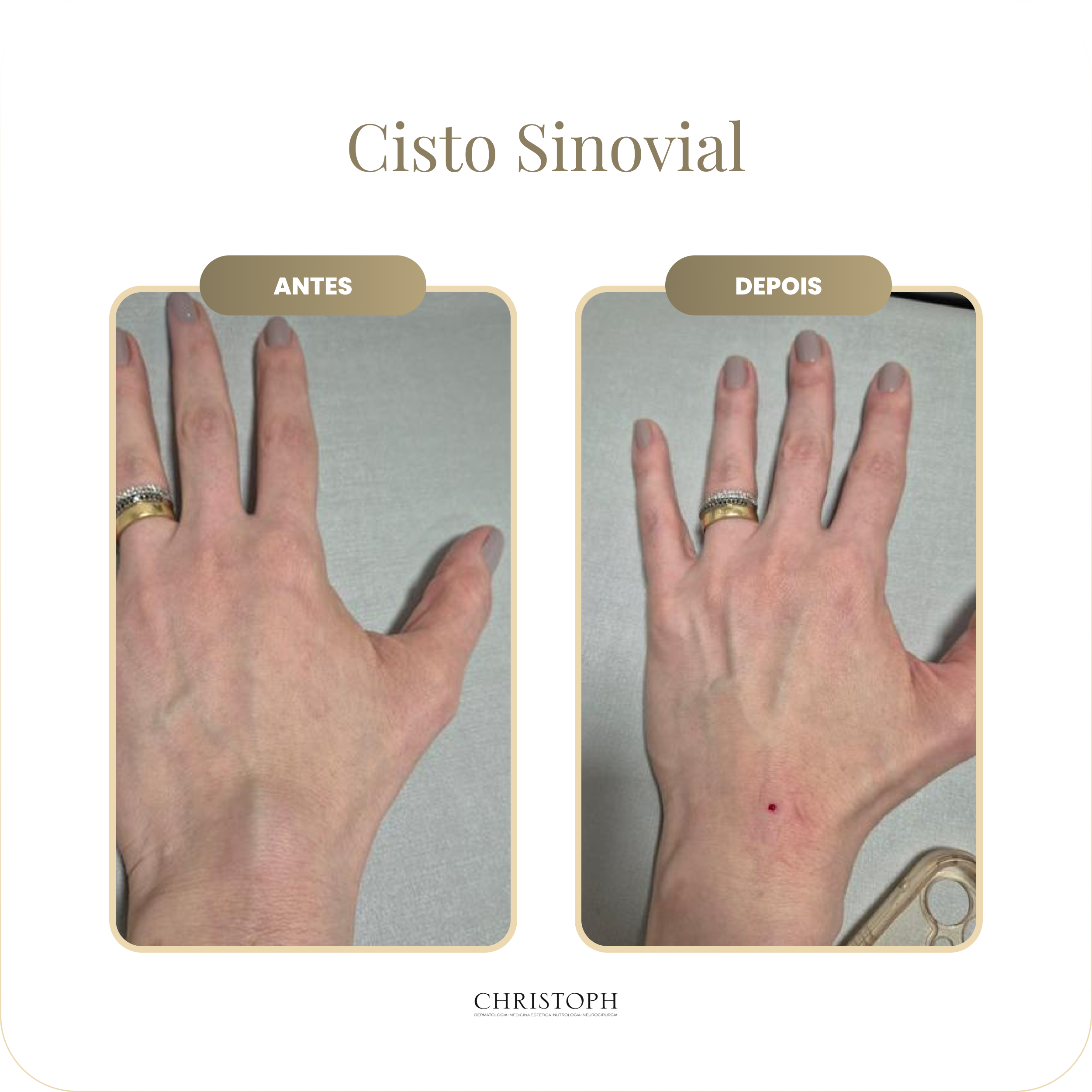 cisto_sinovial.webp