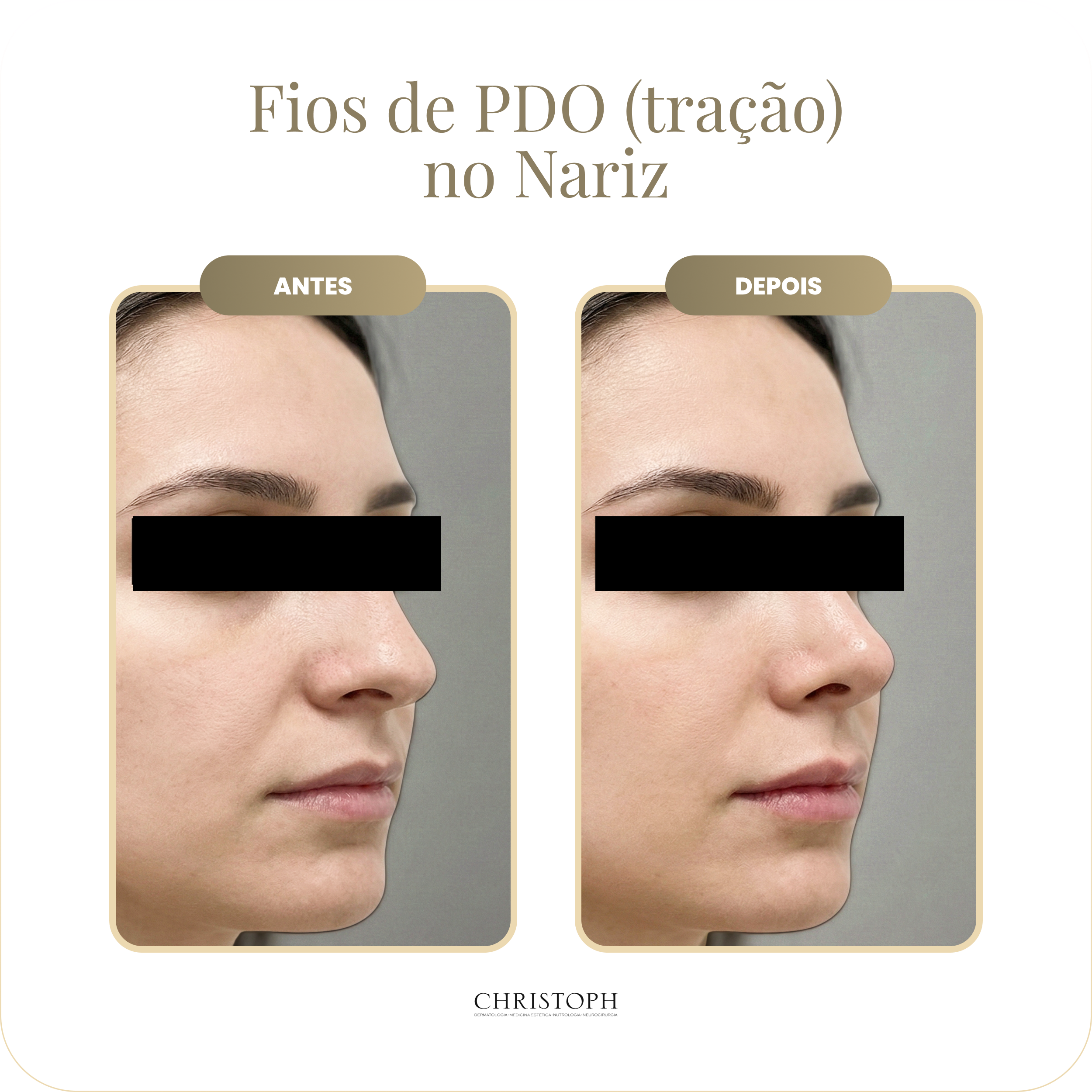 fios_de_pdo_tra_o_no_nariz.webp