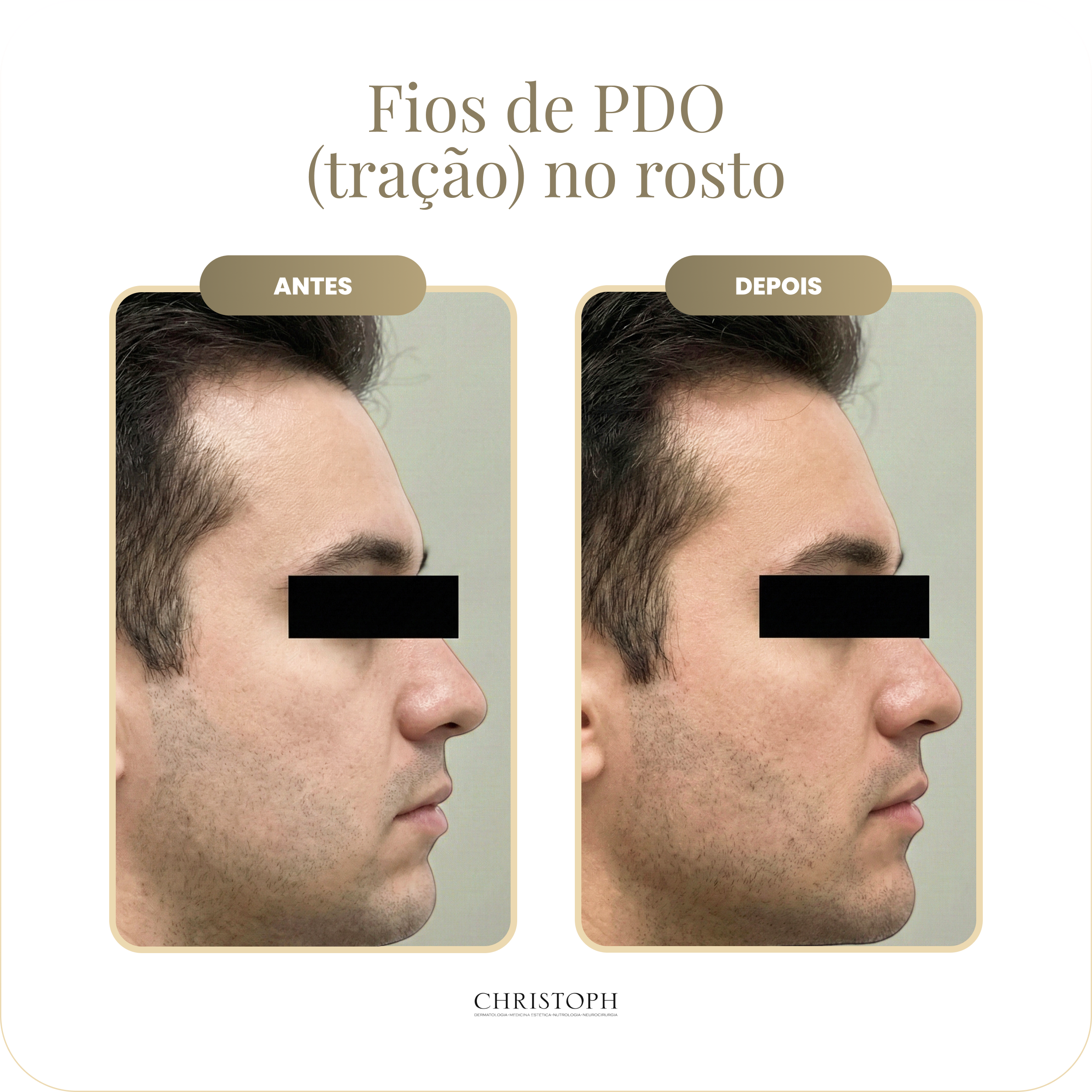 fios_de_pdo_tra_o_no_rosto.webp