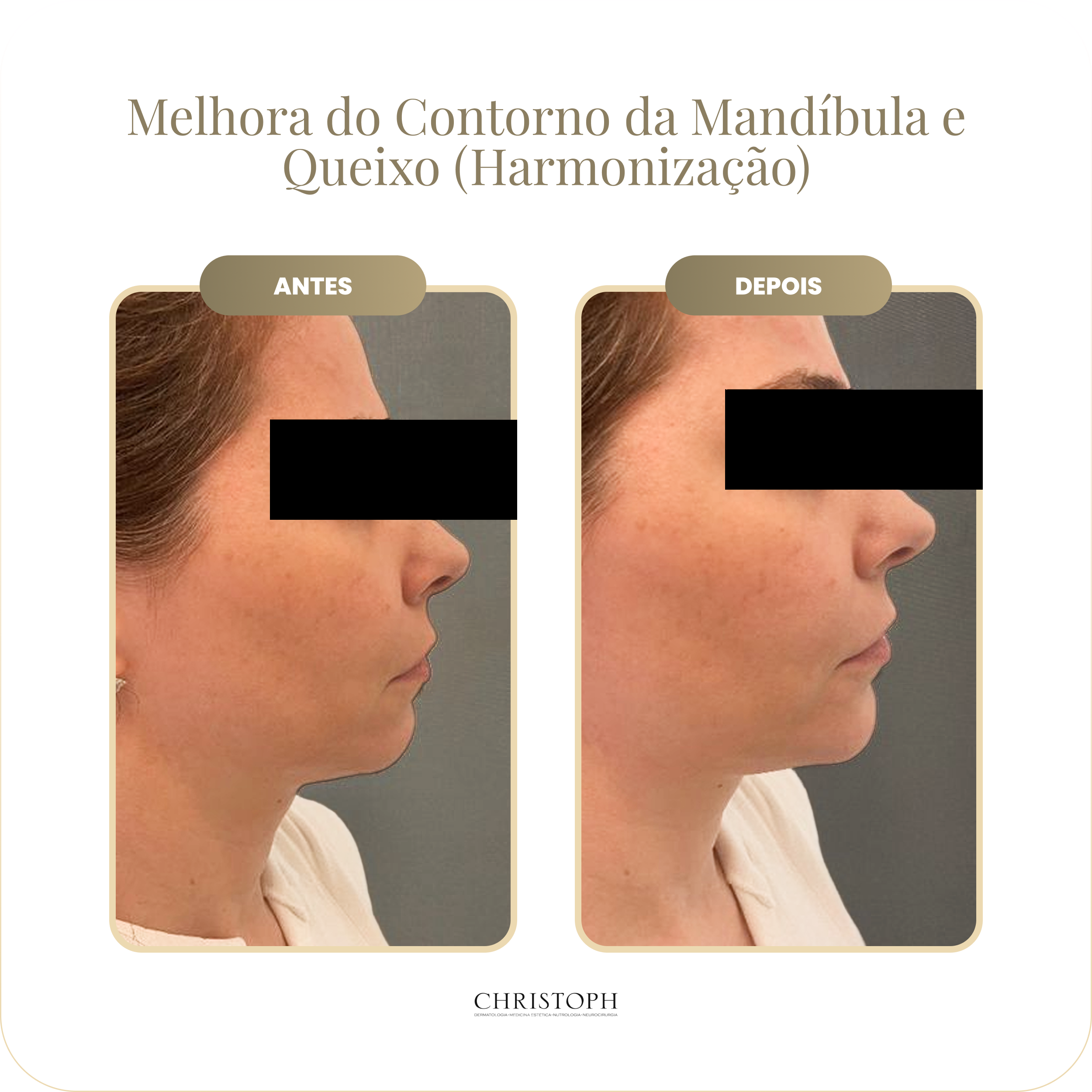melhora_do_contorno_da_mand_bula_e_queixo_harmoniza_o_.webp