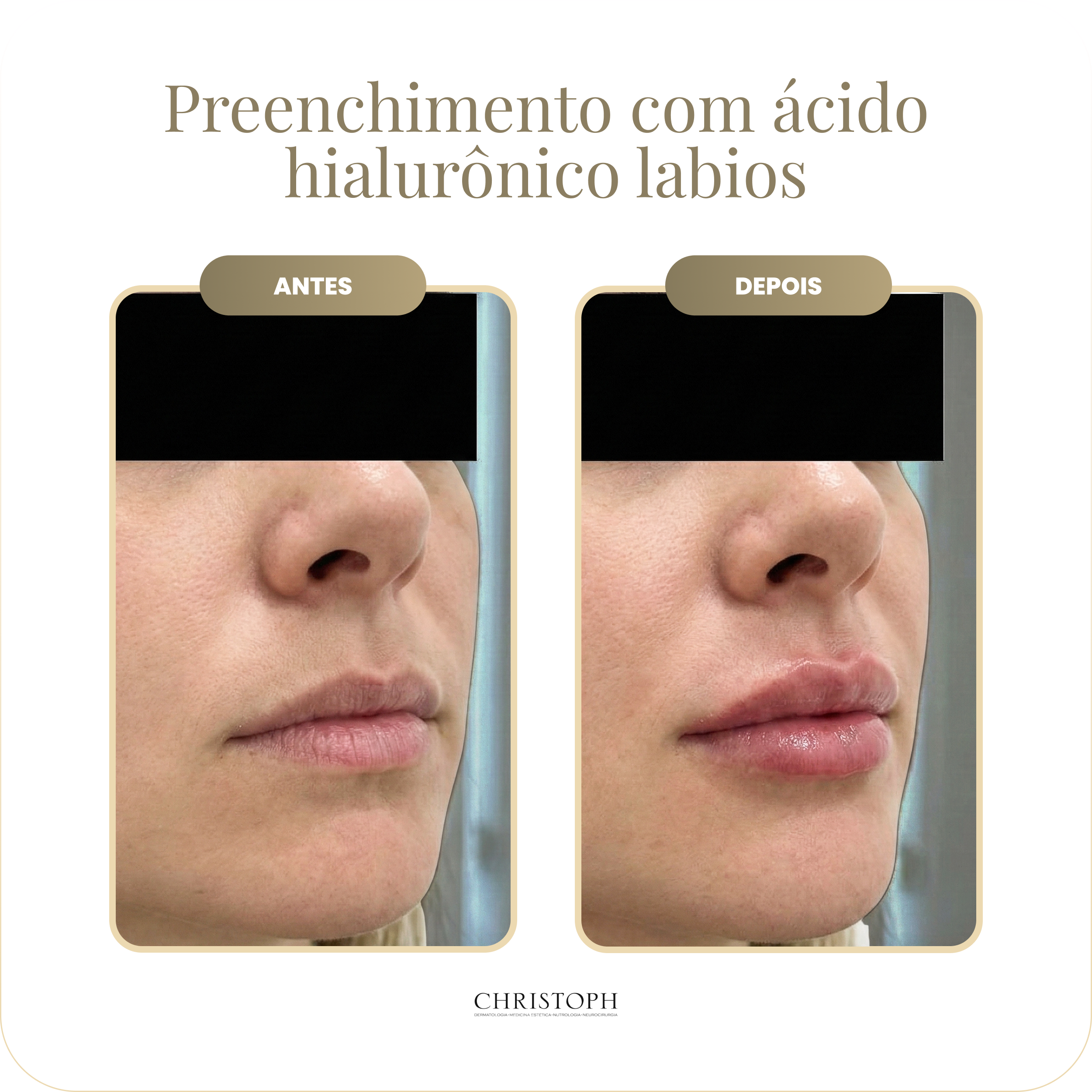 preenchimento_com_cido_hialur_nico_labios.webp