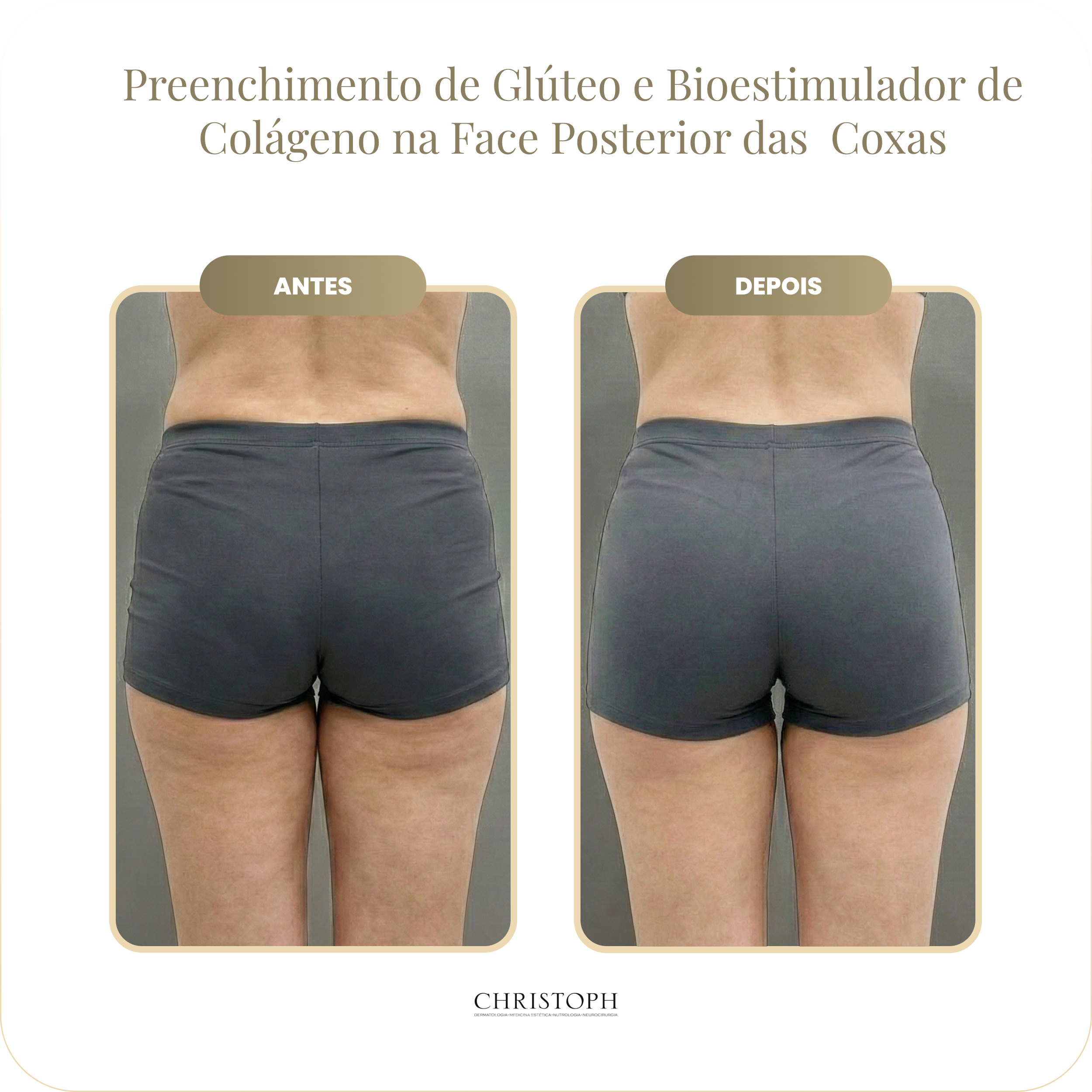 preenchimento_de_gl_teo_e_bioestimulador_de_colageno.webp