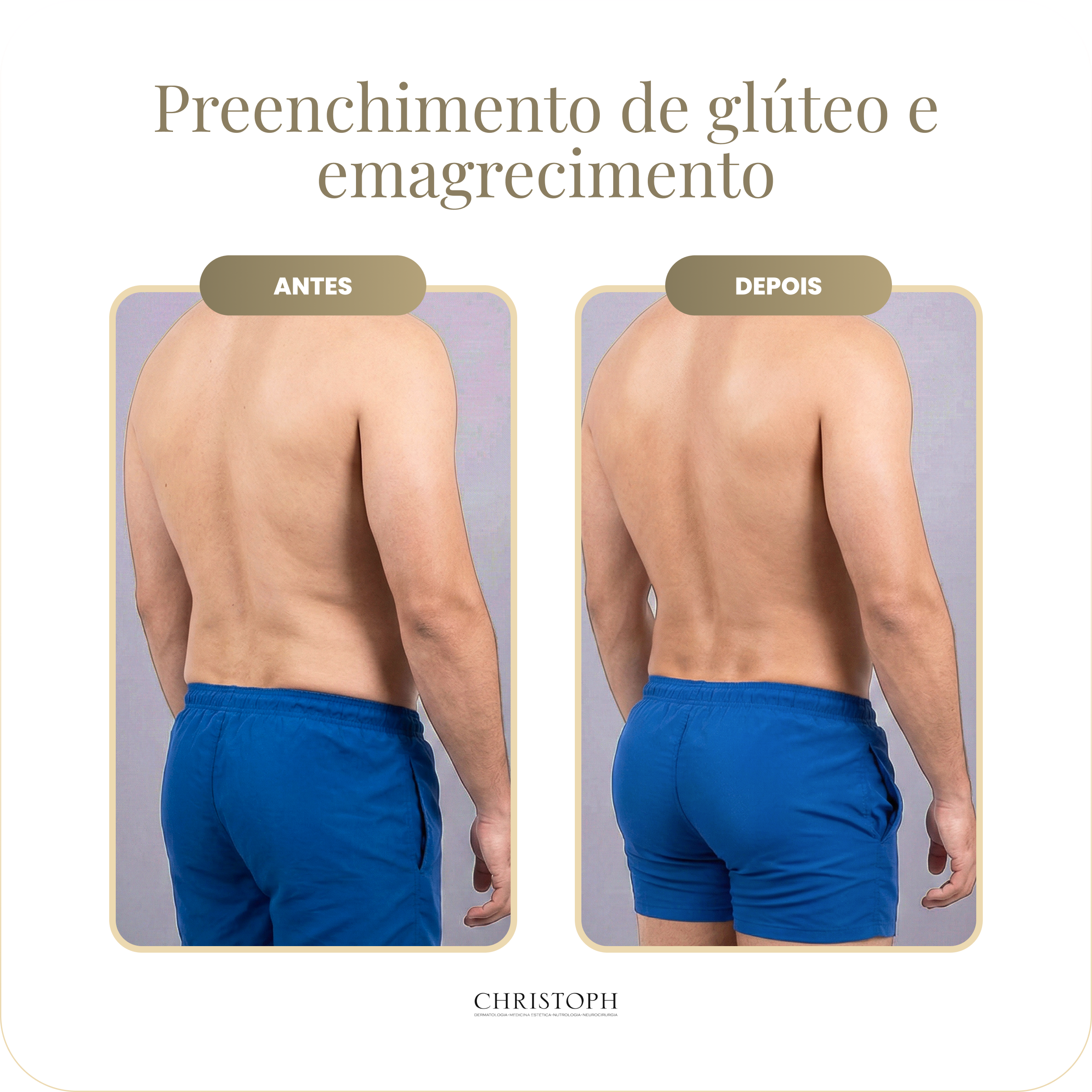 preenchimento_de_gl_teo_e_emagrecimento-homem.webp