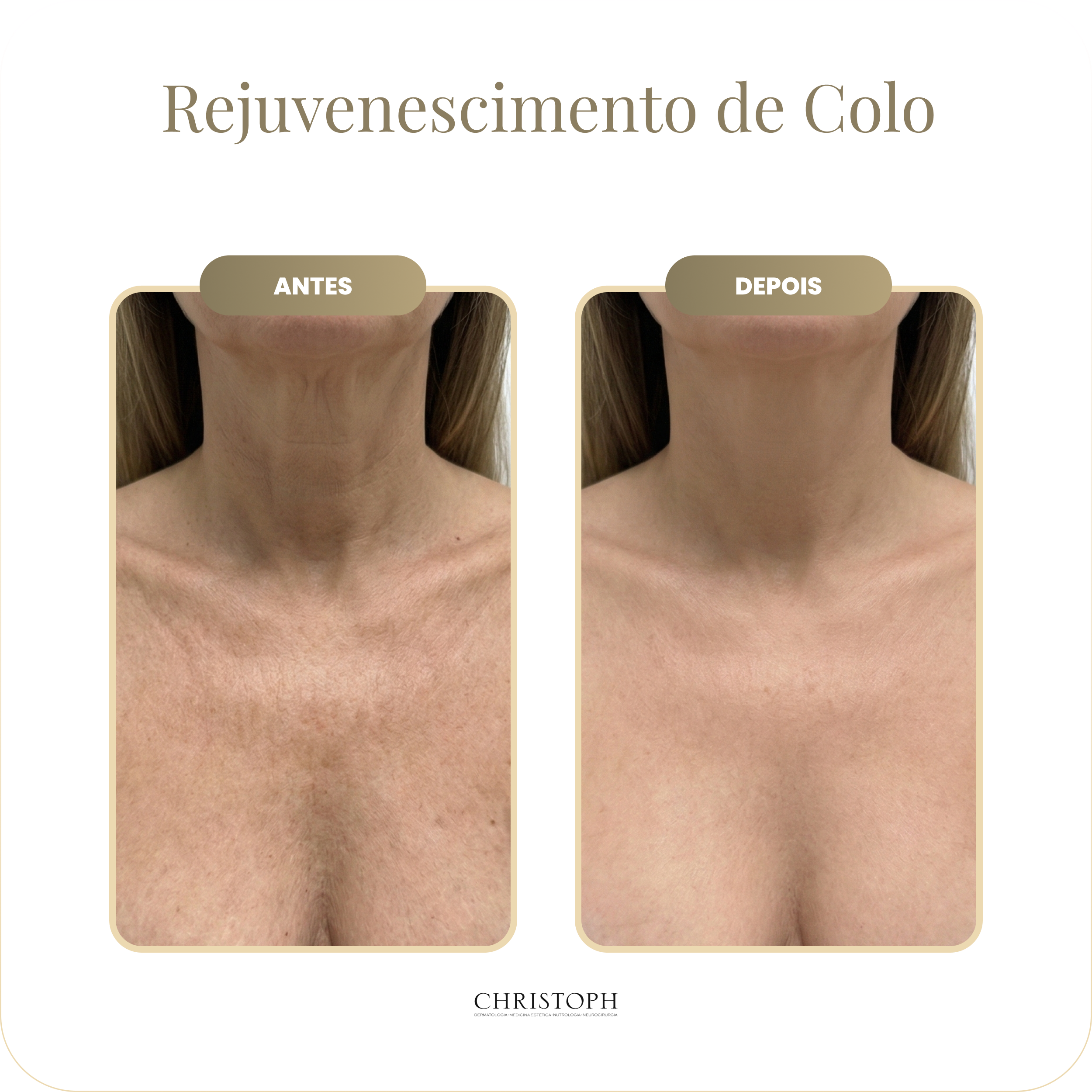 rejuvenescimento_de_colo.webp
