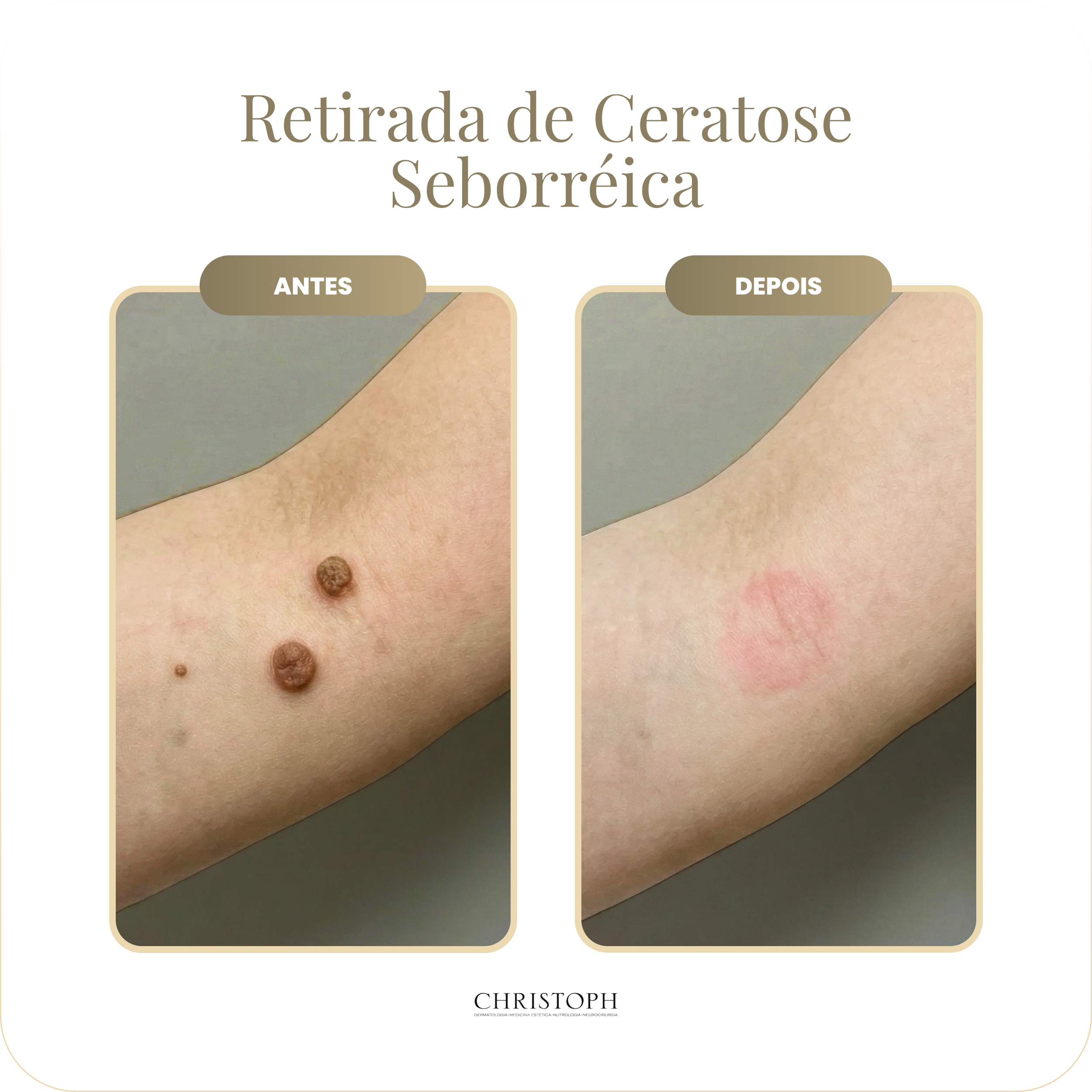 retirada_de_ceratose_seborr_ica.webp