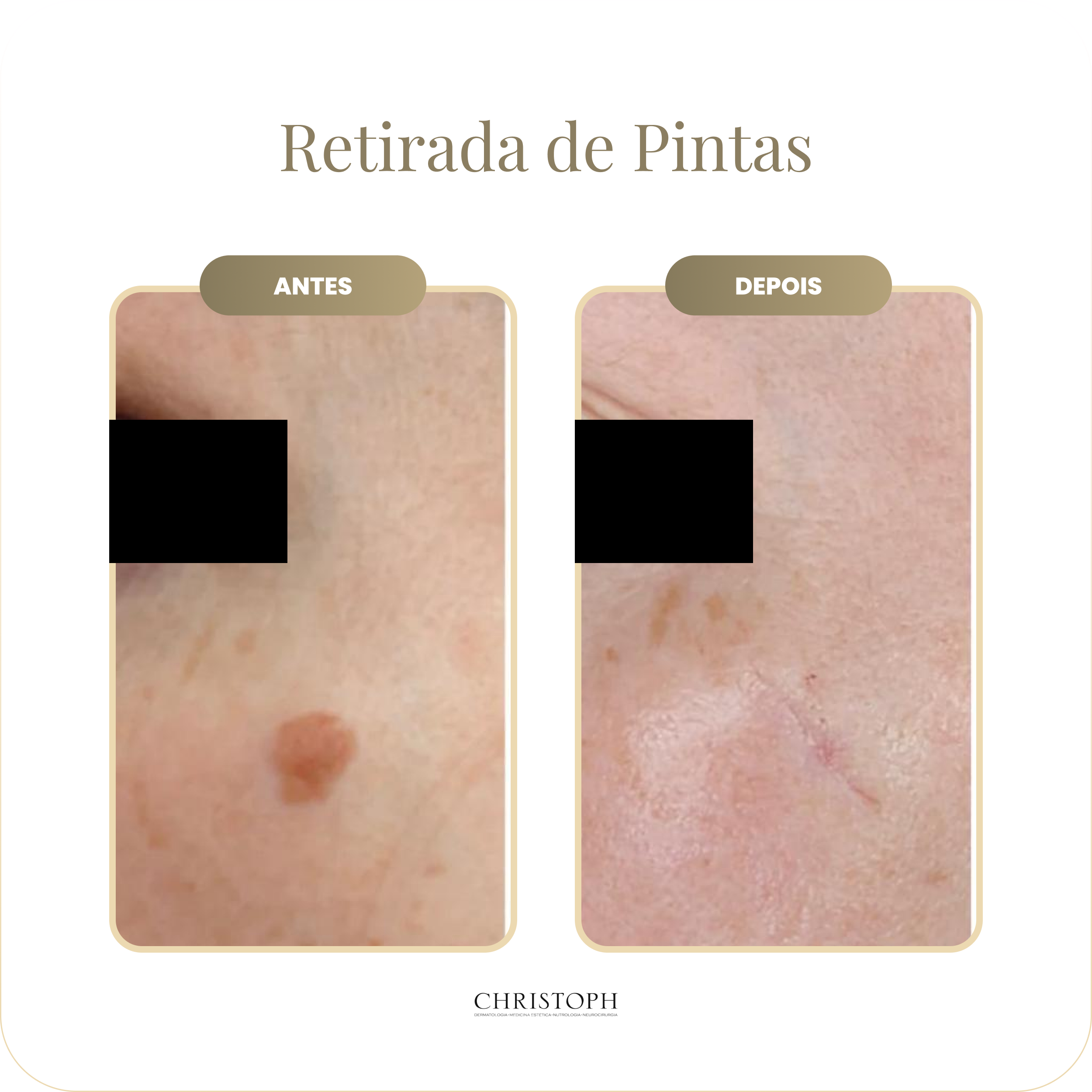 retirada_de_pintas.webp