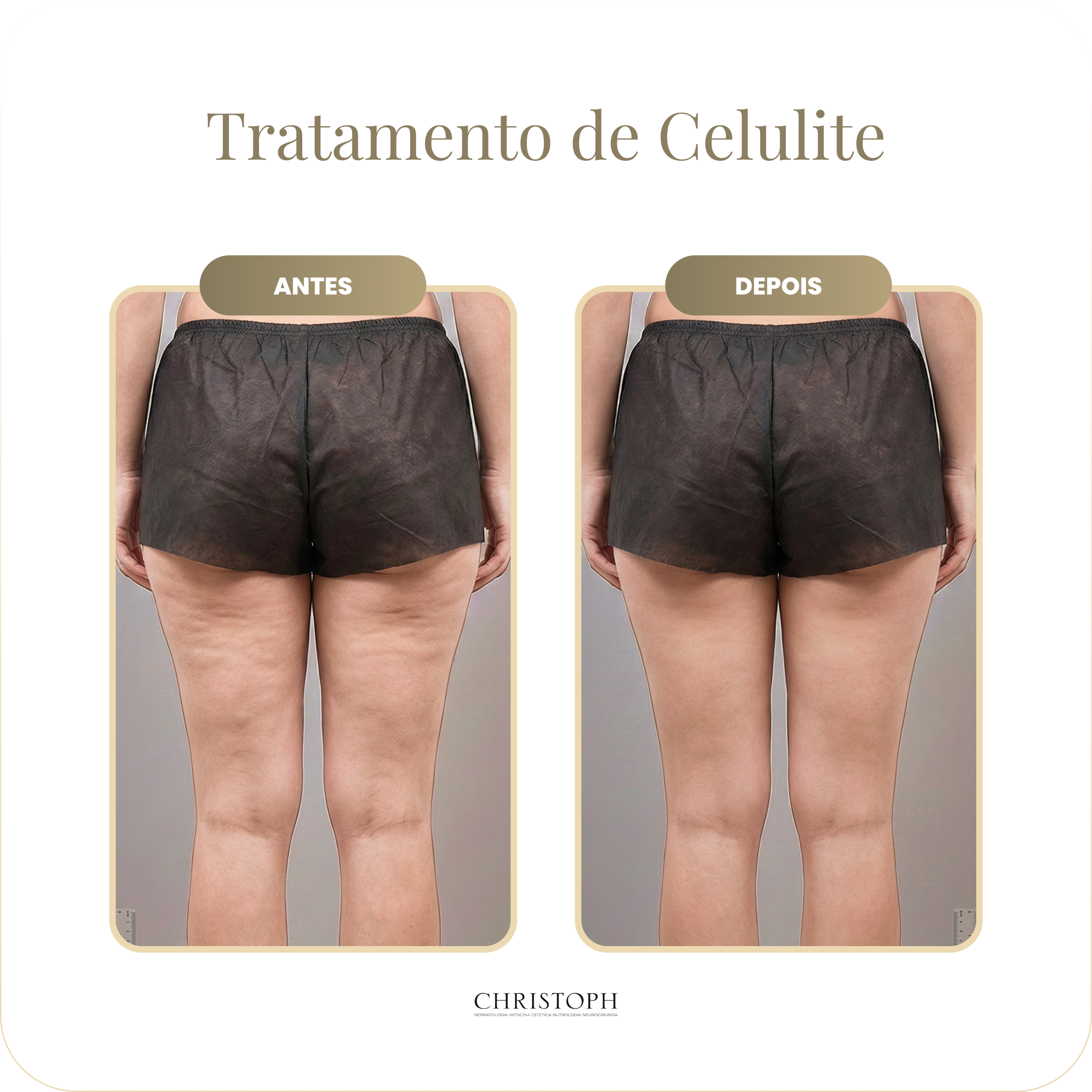 tratamento_de_celulite.webp