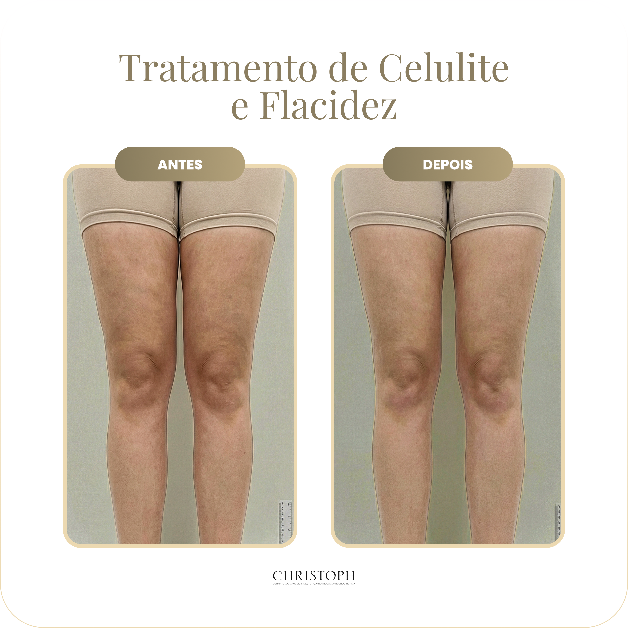 tratamento_de_celulite_e_flacidez.webp