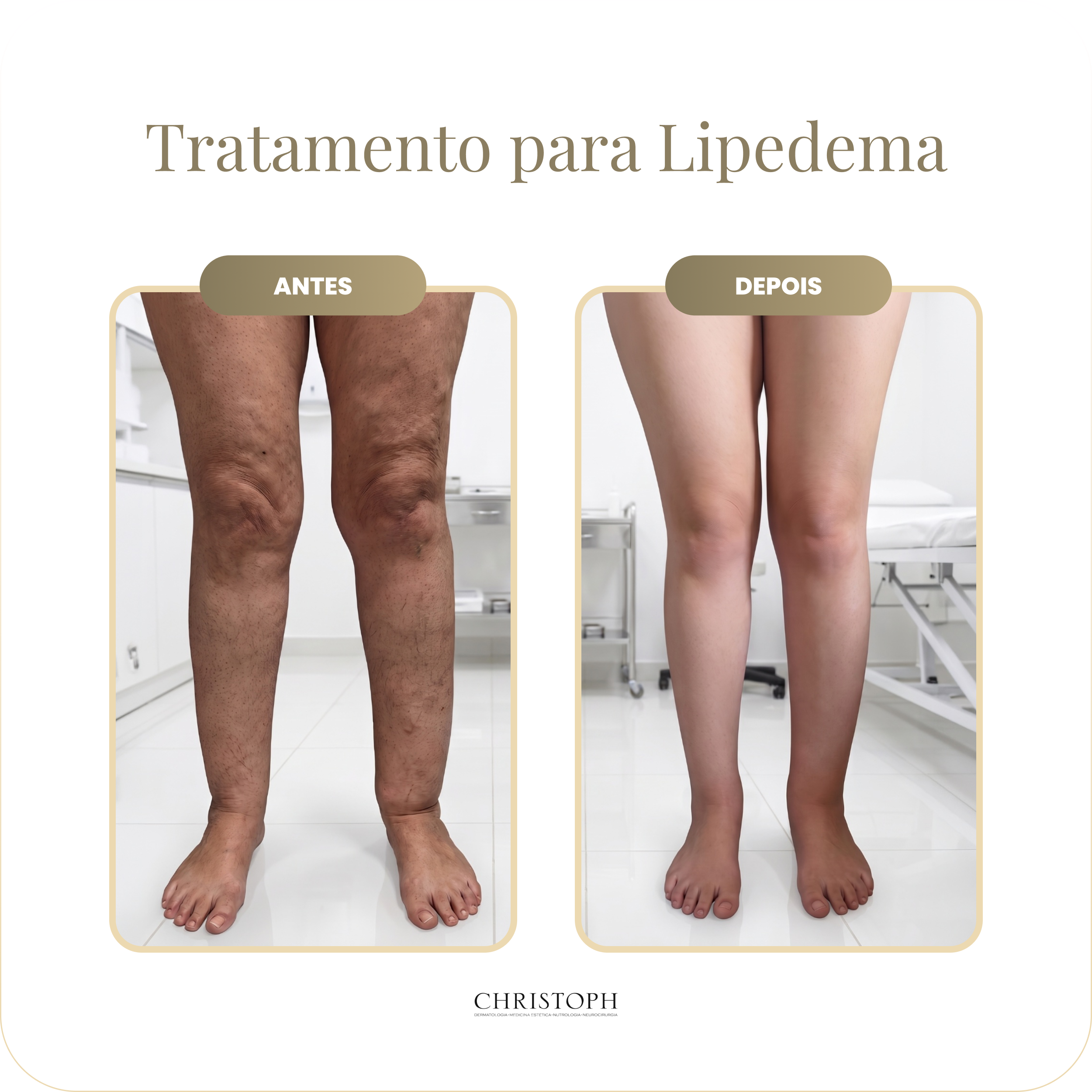 tratamento_para_lipedema.webp